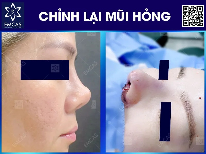 Sửa mũi hỏng là phương pháp khắc phục những trường hợp phẫu thuật thẩm mỹ mũi thất bại