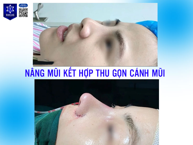 Thông thường sau phẫu thuật thu gọn cánh mũi, mũi sẽ giảm sưng sau khoảng 7–10 ngày và bắt đầu vào form tự nhiên sau 1 tháng