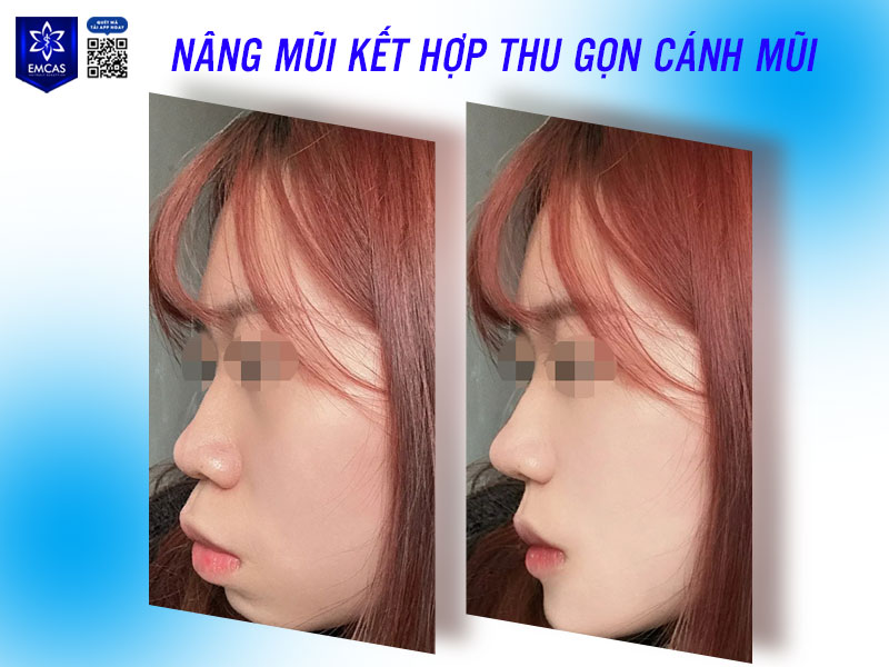 Không phải ai cũng cần phải cắt mũi hoặc cuộn cánh mũi