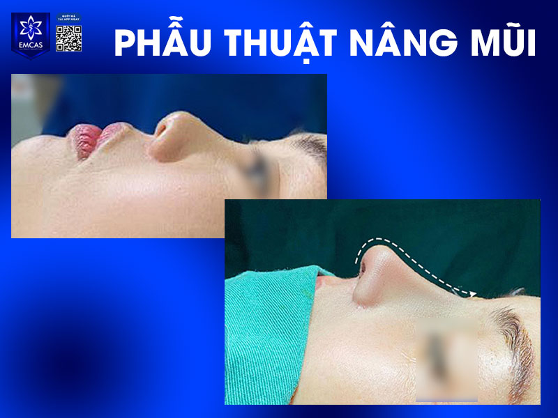 Chăm sóc sau khi nâng mũi đóng vai trò quan trọng trong quy trình nâng mũi