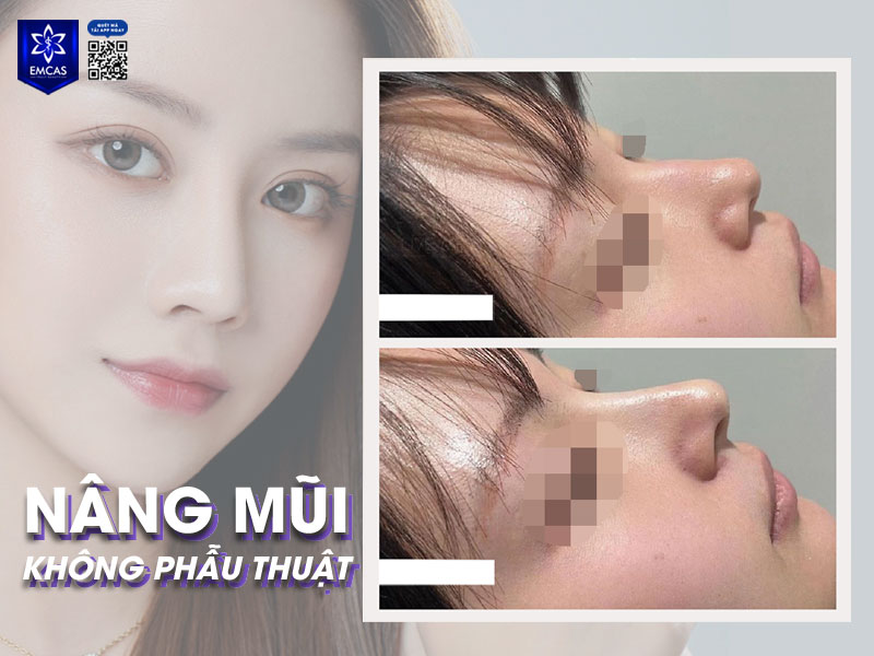 Nâng mũi không phẫu thuật là lựa chọn cho người sợ phẫu thuật và muốn sự thay đổi nhẹ nhàng về dáng mũi