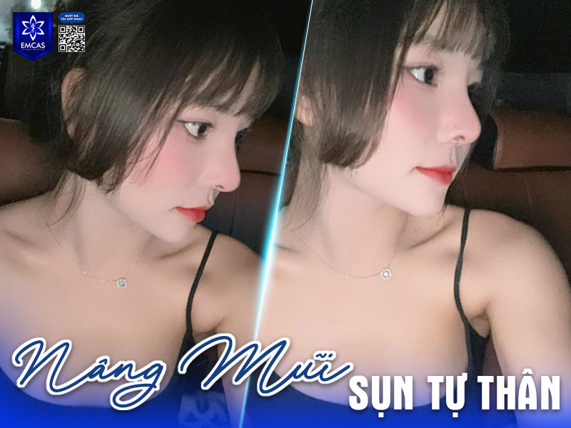 Nâng mũi là một phương pháp thẩm mỹ giúp nâng cao sống mũi, chỉnh sửa dáng mũi