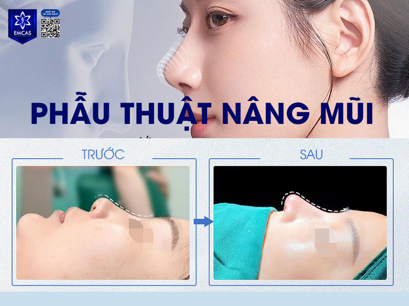 Trước khi nâng mũi, việc cần chuẩn bị tốt cả về thể chất lẫn tinh thần sẽ góp phần giúp ca phẫu thuật diễn ra thuận lợi và an toàn. 