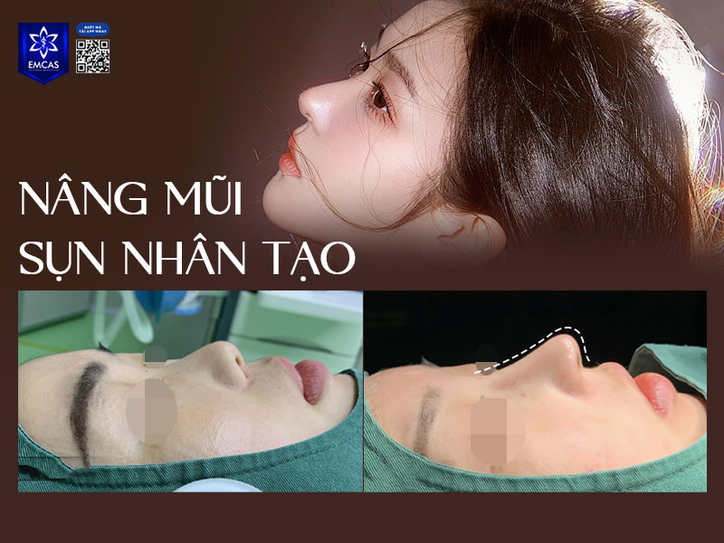 Không phải ai sinh ra cũng có sống mũi dọc dừa lý tưởng nên nhiều người đã tìm đến các giải pháp thẩm mỹ hiện để tiến hành chỉnh sửa mũi