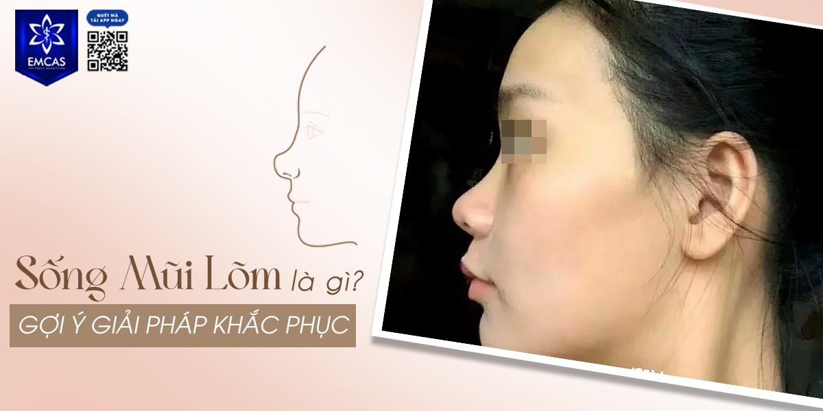 SỐNG MŨI LÕM LÀ GÌ? CÁCH KHẮC PHỤC HIỆU QUẢ