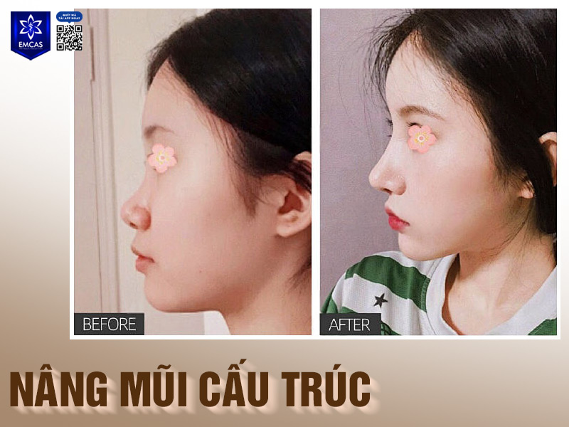 Tùy vào từng tình trạng mũi của mỗi người mà bác sĩ sẽ tư vấn phương pháp và thiết kế dáng mũi phù hợp với cấu trúc khuôn mặt.