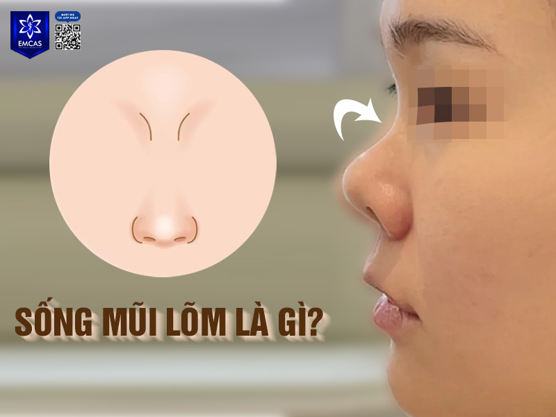 Sống mũi lõm là tình trạng phần sống mũi thấp, bị lõm vào trong so với tổng thể gương mặt, tạo thành đường cong ở phần đầu mũi