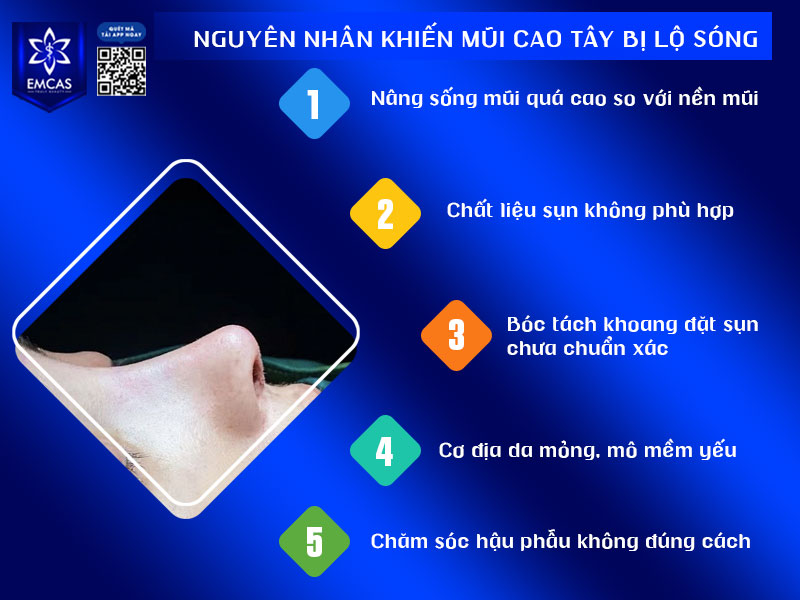 Tình trạng mũi cao tây lộ sóng không xảy ra ngẫu nhiên mà do nhiều yếu tố ảnh hưởng như kỹ thuật phẫu thuật, cơ địa và quá trình chăm sóc hậu phẫu. 