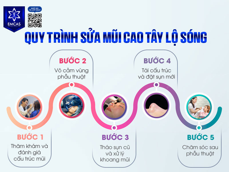 Sửa mũi cao tây lộ sóng là một dạng phẫu thuật chỉnh sửa phức tạp hơn so với nâng mũi lần đầu