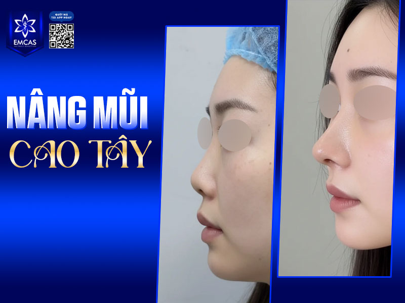 Trong những năm gần đây, phong cách mũi cao tây trở thành xu hướng được nhiều người lựa chọn, đặc biệt là nhóm khách hàng trẻ yêu thích vẻ đẹp sắc sảo, cá tính
