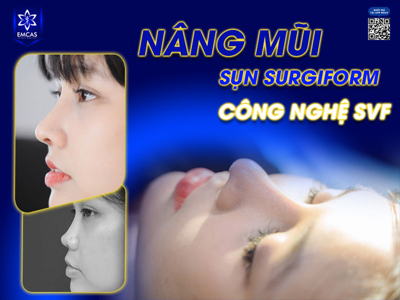 Sụn Surgiform được làm từ vật liệu y tế an toàn ePTFE, giúp duy trì kết quả thẩm mỹ từ 15-20 năm