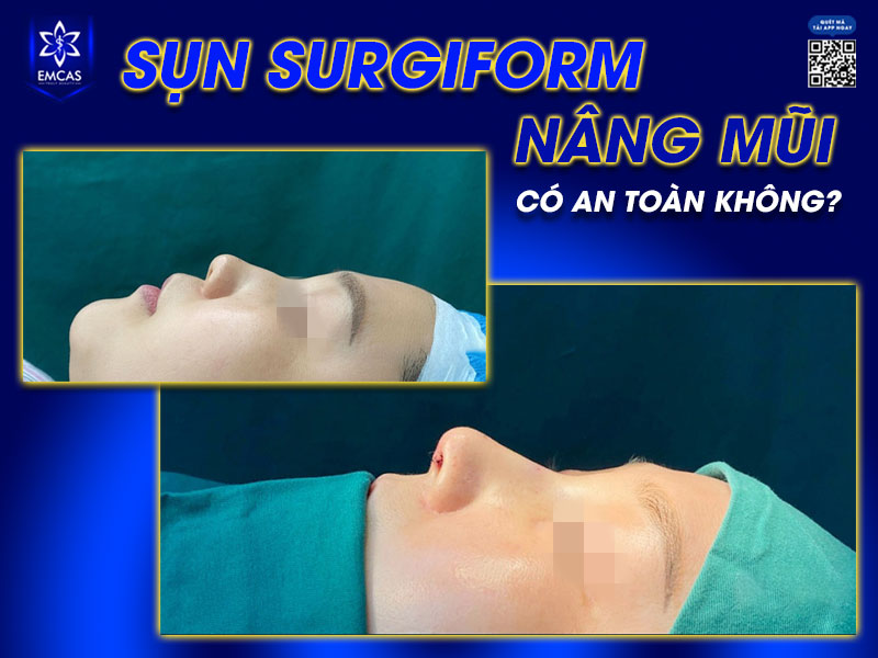 Surgiform nâng mũi là một lựa chọn được giới chuyên môn đánh giá cao về độ an toàn và hiệu quả