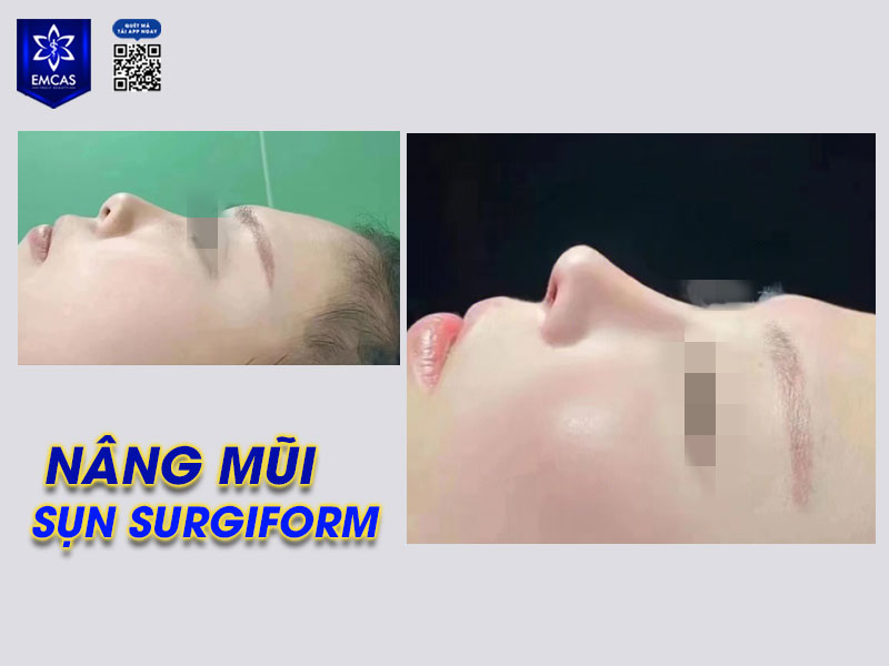 Việc lựa chọn bác sĩ và cơ sở nâng mũi cũng có ảnh hưởng không nhỏ đến kết quả thẩm mỹ sau cùng