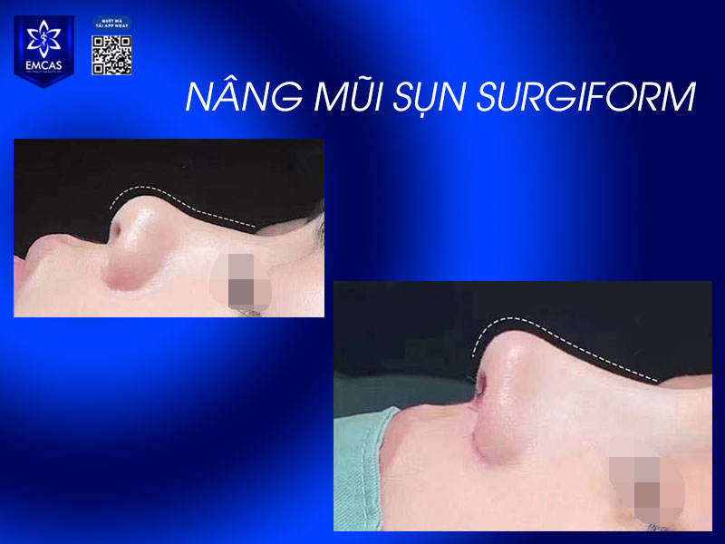 Sụn Surgiform có cấu tạo với nhiều lỗ nhỏ cho phép mạch máu lưu thông, giúp tăng khả năng bám dính