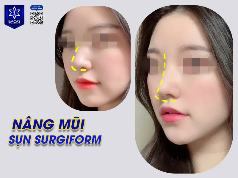 nâng mũi bằng sụn Surgiform cần từ 3-6 tháng để dáng mũi ổn định, vào form