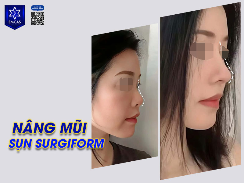 nâng mũi sụn surgiform phù hợp với người có da mũi mỏng, cơ địa nhạy cảm