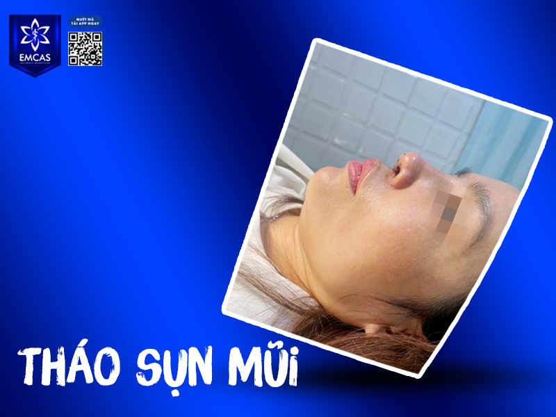 Tháo sụn mũi là thủ thuật bác sĩ tiến hành lấy bỏ phần sụn nhân tạo hoặc sụn tự thân (sụn tai, sụn sườn, sụn vách ngăn) đã được đặt vào trong quá trình nâng mũi trước đó