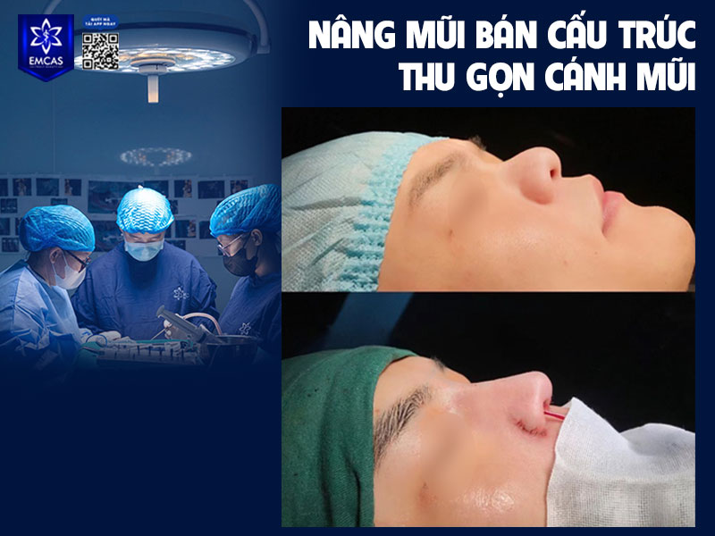 Tùy vào phương pháp thực hiện thu gọn cánh mũi cũng như cơ sở thẩm mỹ mà chi phí sẽ có sự chênh lệch.