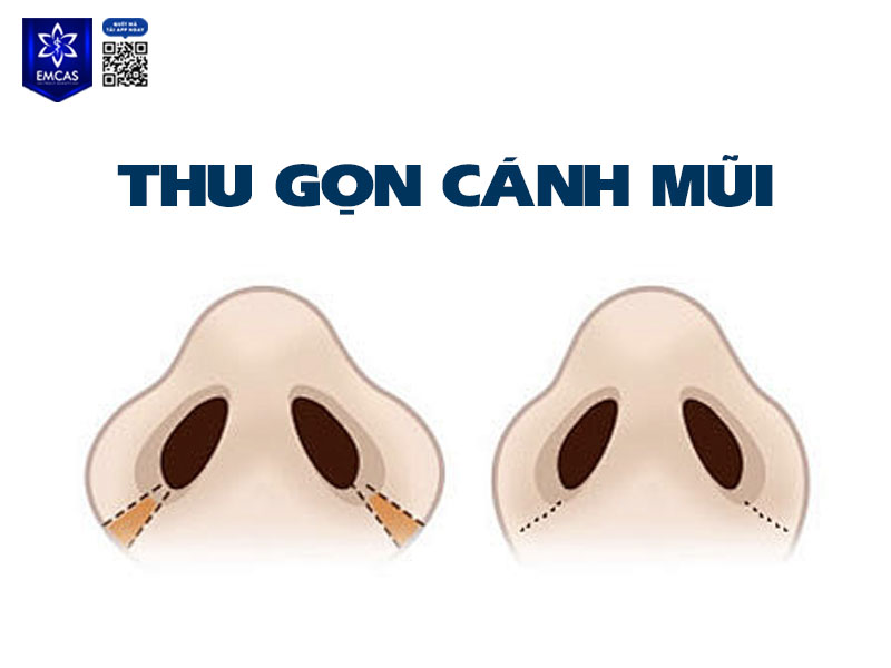 Thu gọn cánh mũi là giải pháp phù hợp với người có cánh mũi to, bè, hoặc lỗ mũi rộng, khiến gương mặt mất cân đối và kém thanh thoát.