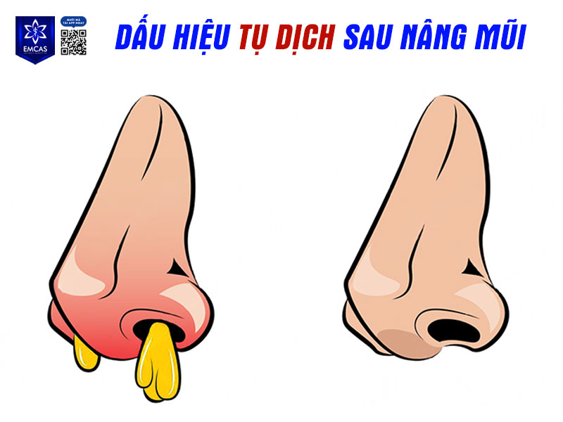 Tụ dịch là một trong những biến chứng nhẹ thường gặp, tương tự việc tụ chất lỏng dưới da, thường có màu trắng hoặc vàng, có mùi và gây đau tại vùng phẫu thuật