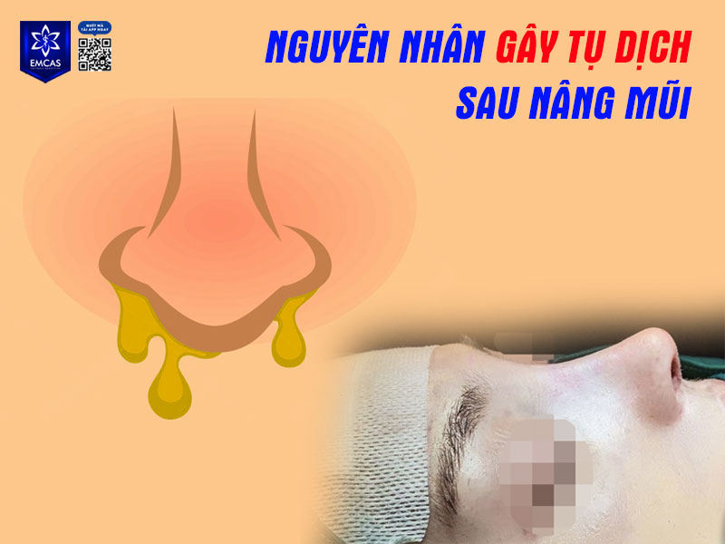 Tụ dịch xảy ra khi có sự ứ đọng chất lỏng dưới da, gây mùi, đau, khó chịu