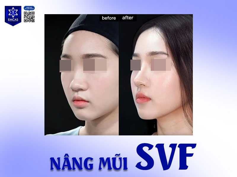 Tướng mũi củ tỏi không xấu – nhưng nếu bạn cảm thấy không hài lòng với dáng mũi của mình, hoàn toàn có thể lựa chọn chỉnh sửa