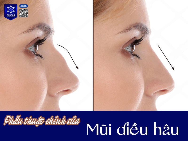 Bác sĩ sẽ thực hiện kỹ thuật chỉnh hình sống mũi gồ, thu gọn đầu mũi và điều chỉnh độ khoằm để tạo dáng mũi thẳng, mềm mại hơn