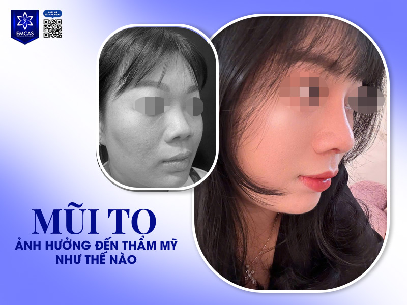 Khi lỗ mũi to và lộ rõ, đặc biệt nhìn trực diện, sẽ khiến khuôn mặt mất đi sự hài hòa, thanh thoát và dễ tạo cảm giác kém duyên