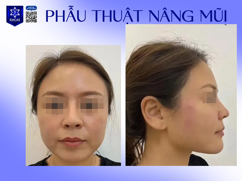Phẫu thuật nâng mũi là giải pháp bền vững, phù hợp với những ai mong muốn sở hữu dáng mũi đẹp chuẩn tỉ lệ vàng và khắc phục triệt để khuyết điểm mũi to