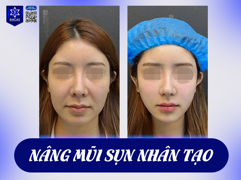 Việc chỉnh sửa mũi là hoàn toàn có thể nếu bạn mong muốn cải thiện ngoại hình, nâng cao sự tự tin nhưng vẫn giữ được nét hài hòa và tự nhiên