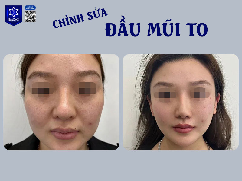 Việc sửa mũi đối với tướng phụ nữ đầu mũi to hoàn toàn có thể cân nhắc, không chỉ để cải thiện vẻ ngoài mà còn nhằm tạo sự hài hòa về thẩm mỹ ngũ quan và yếu tố phong thủy
