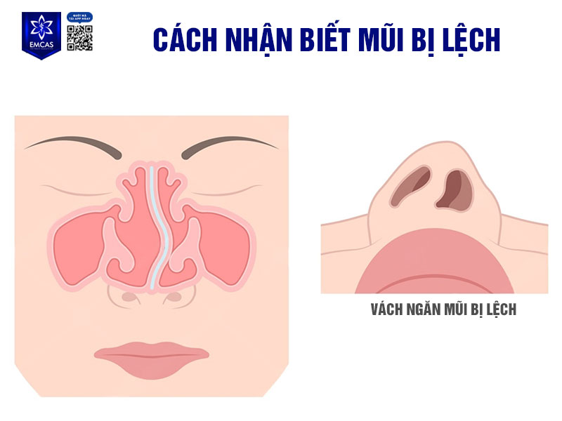 Vách ngăn mũi bị lệch khiến ống mũi bị hẹp một bên làm cho luồng không khí đi qua gây ra tiếng ngáy hoặc tiếng thở lớn khi ngủ