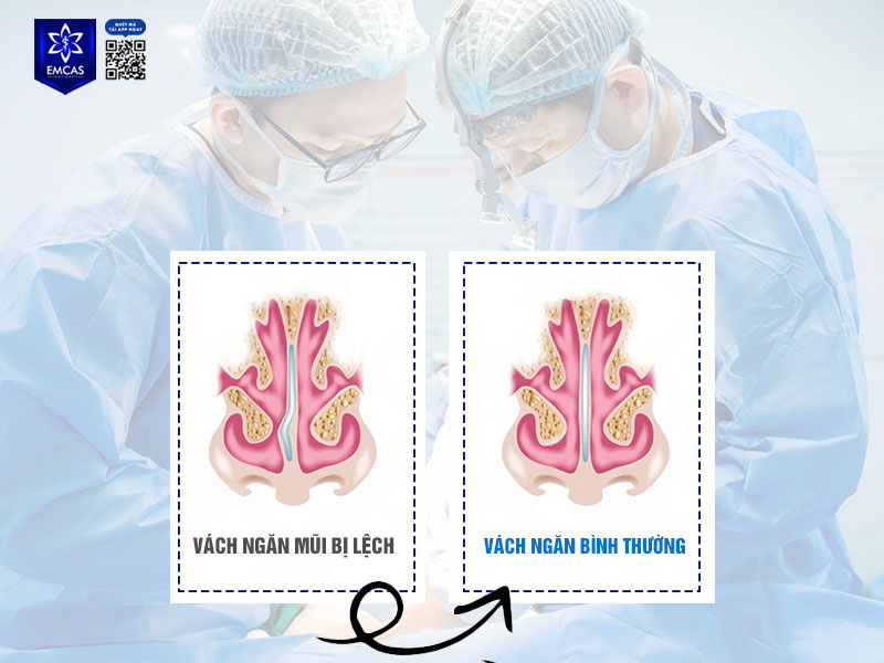 Phẫu thuật vách ngăn mũi được xem là giải pháp tối ưu cho những ai gặp tình trạng vách ngăn mũi bị lệch nặng, ảnh hưởng đến thẩm mỹ và sức khỏe.
