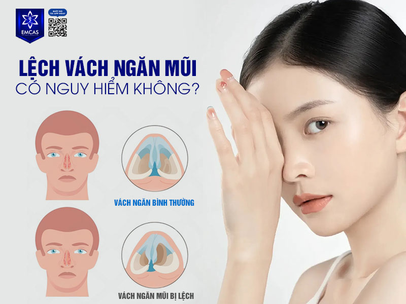 Lệch vách ngăn mũi sẽ làm ảnh hưởng đến thẩm mỹ và gây khó chịu khi thở, thậm chí là gây nghẹt mũi kéo dài, viêm xoang, ngủ ngáy