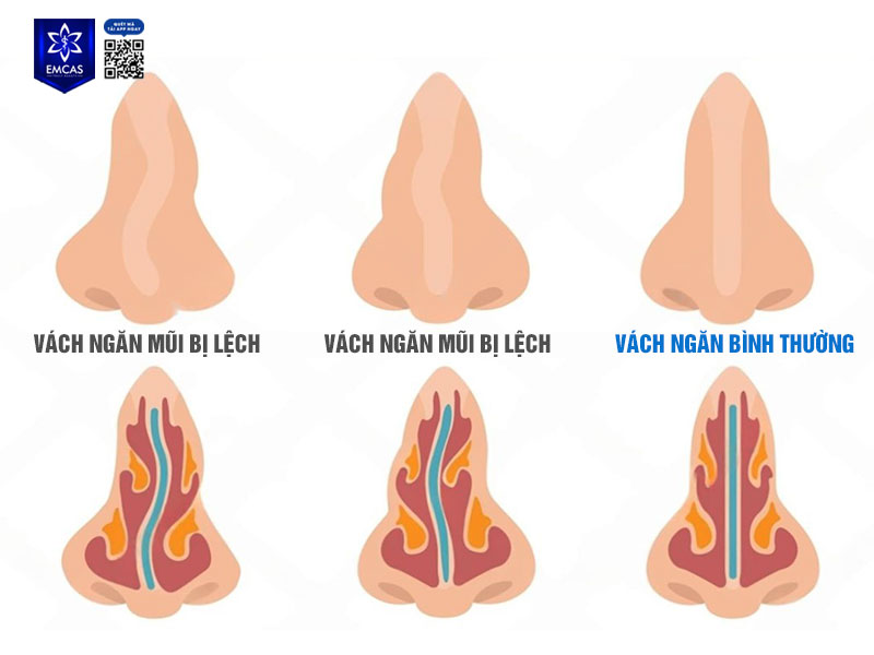 Vách ngăn mũi bị lệch là hiện tượng phần vách ngăn này không thẳng, mà bị dịch chuyển sang một bên, gây mất cân đối trong cấu trúc mũi.