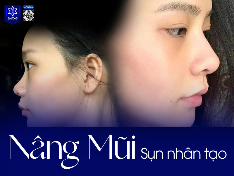 Với những tướng mũi phụ nữ chưa hài hòa, phẫu thuật nâng mũi là giải pháp tối ưu giúp cải thiện hình dáng mũi rõ rệt và lâu dài