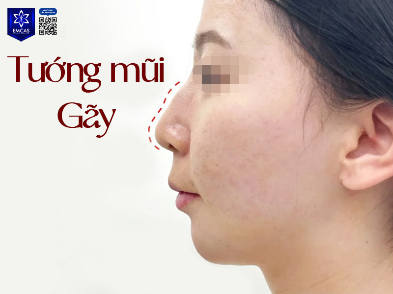 Tướng mũi gãy thường được cho là ảnh hưởng không tốt đến vận mệnh và thẩm mỹ khuôn mặt