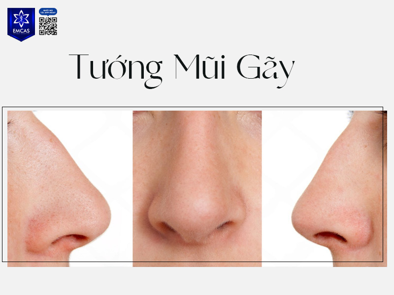 Tướng mũi gãy thường có sống mũi bị gãy khúc, không liền mạch, khiến khuôn mặt thiếu sự hài hòa