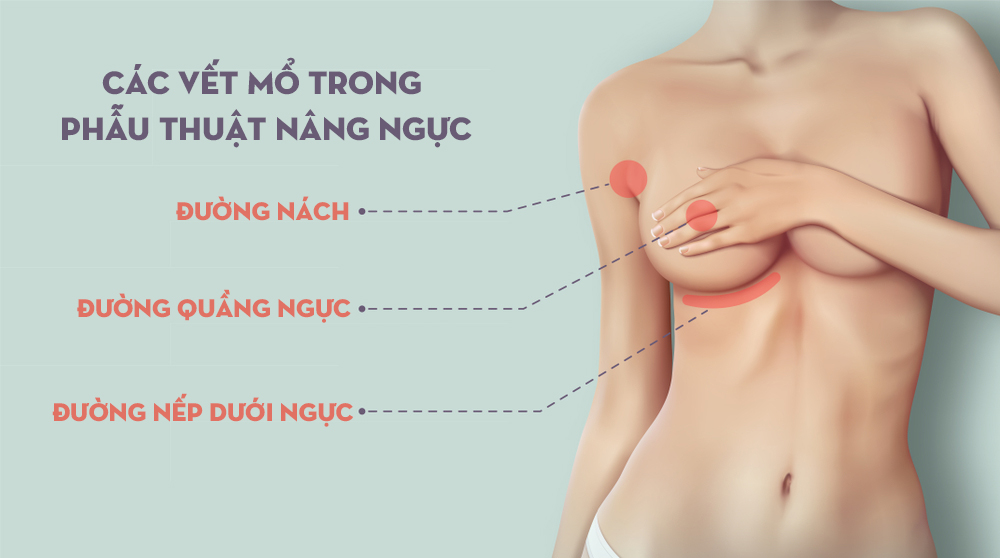 Cách Chọn Đường Mổ Cho Phẫu Thuật Nâng Ngực