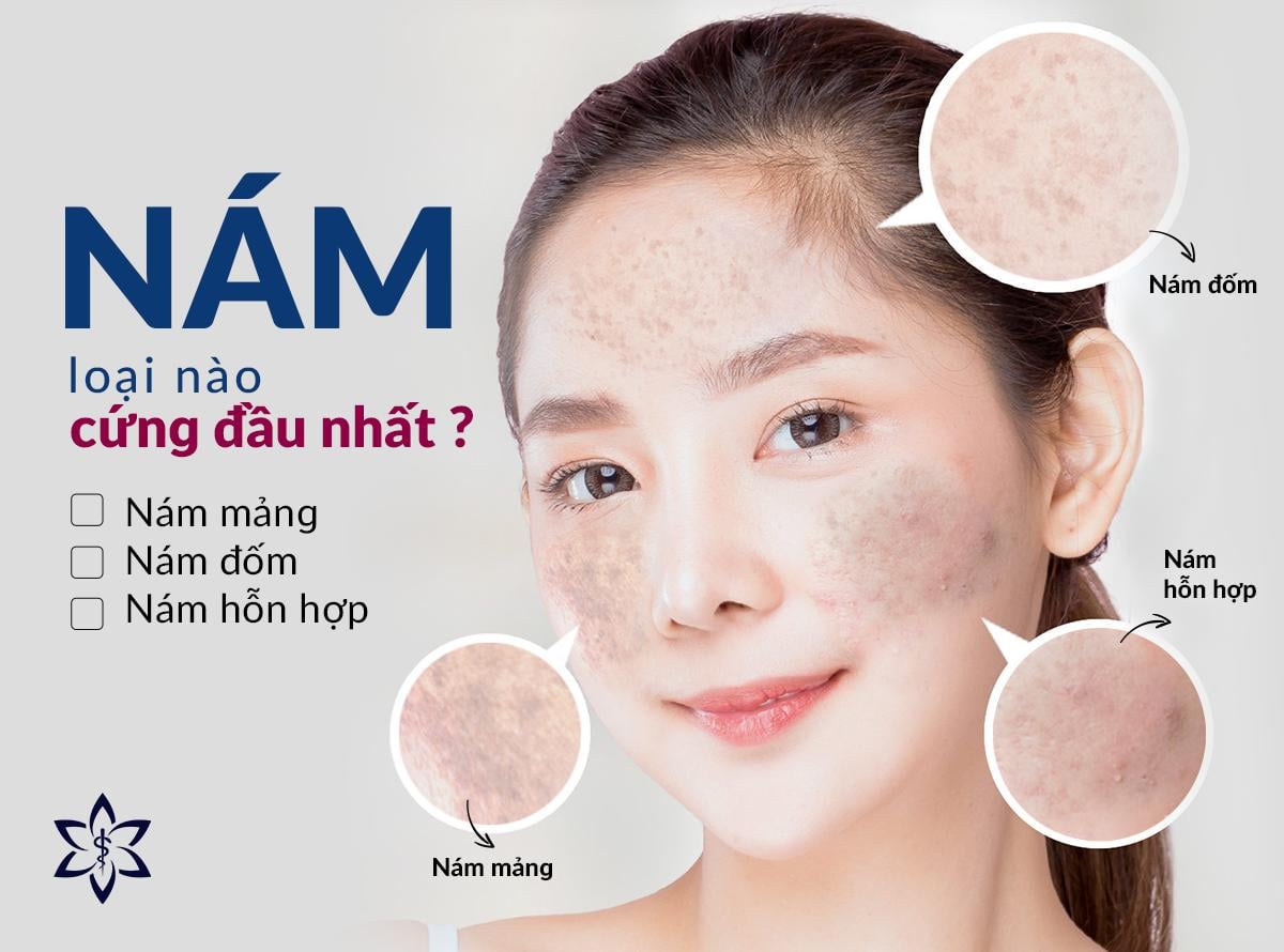 ĐIỀU TRỊ NÁM
