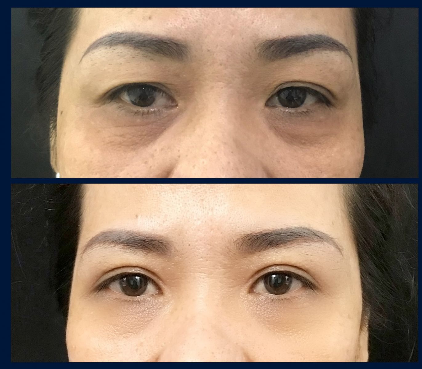 TẠO MÍ ĐÔI QUA ĐƯỜNG NẾP MÍ