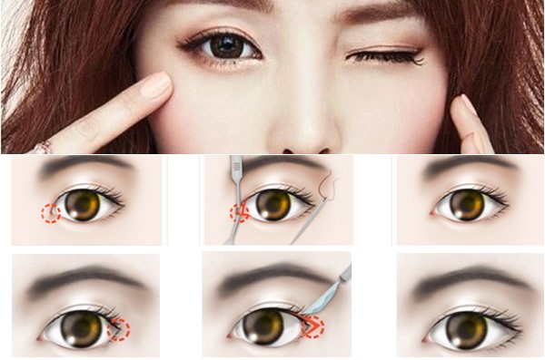 MỞ RỘNG GÓC MẮT