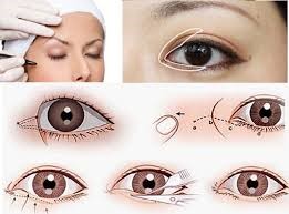 MỞ RỘNG GÓC MẮT