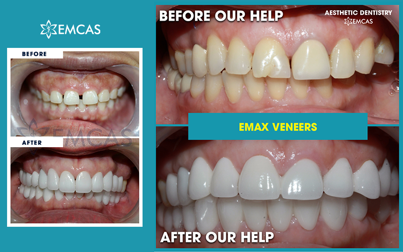 DENTAL VENEER