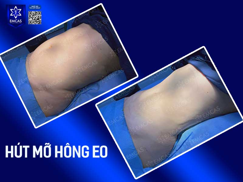 Bệnh viện thẩm mỹ EMCAS là một trong những cơ sở làm đẹp được nhiều người tin tưởng lựa chọn hiện nay với nhiều trang thiết bị tiến tiến, máy móc công nghệ hiện đại