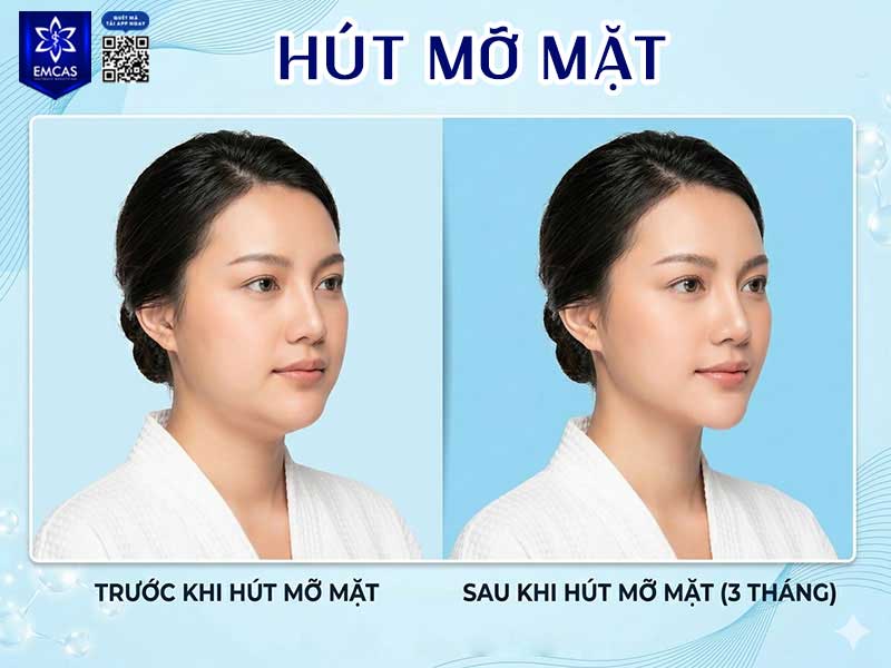 Hút mỡ vùng mặt phù hợp hơn với người có mỡ khu trú ở vùng mặt, sức khỏe đủ điều kiện can thiệp và kỳ vọng thẩm mỹ thực tế sau khi được bác sĩ đánh giá trực tiếp.