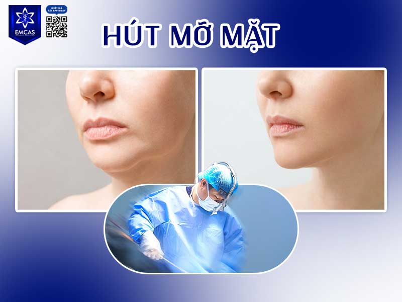 Hút mỡ vùng mặt là phương pháp thẩm mỹ sử dụng kỹ thuật hút mỡ chuyên dụng để xử lý mỡ thừa khu trú ở vùng má, nọng cằm hoặc dưới hàm, giúp khuôn mặt gọn gàng và rõ đường nét hơn.