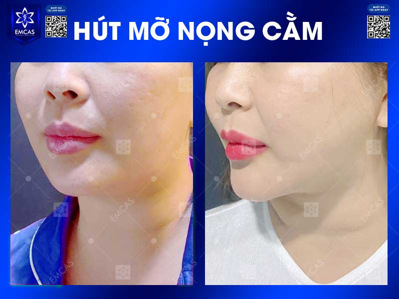 Thăm khám tại EMCAS giúp khách hàng được bác sĩ đánh giá nguyên nhân khiến khuôn mặt trông đầy, xác định vùng mỡ cần xử lý và lựa chọn phương án tạo hình phù hợp