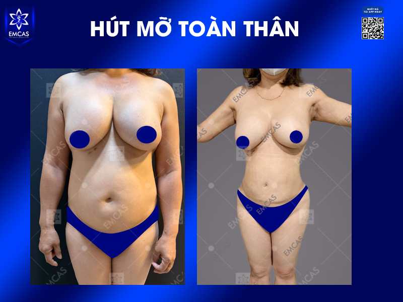 Hút mỡ toàn thân có thể tiềm ẩn rủi ro như mọi phẫu thuật xâm lấn, vì vậy mức độ an toàn phụ thuộc vào tình trạng sức khỏe của người thực hiện, chỉ định của bác sĩ, bác sĩ thực hiện, phạm vi can thiệp