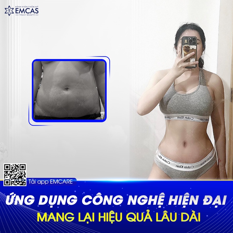 Tùy vào tình trạng da dư, mỡ thừa, độ chùng nhão vùng bụng và mức độ giãn cơ thành bụng, bác sĩ sẽ tư vấn phương pháp tạo hình thành bụng phù hợp